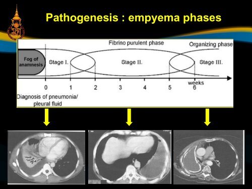 Pathogenesis : empyema phases