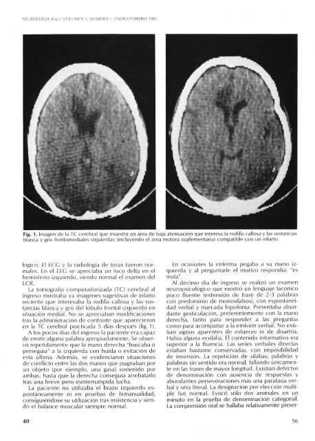 (pdf primer nÃºmero). - Sociedad EspaÃ±ola de NeurologÃ­a