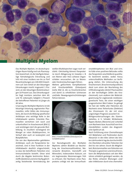 Multiples Myelom - Sachsen-Anhaltische Krebsgesellschaft e.V.