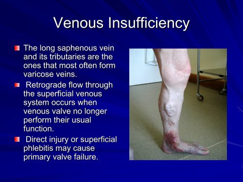 Venous Disease