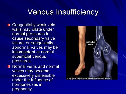 Venous Disease