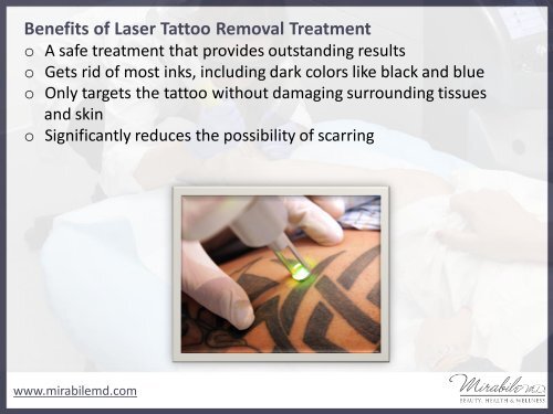 Laser Tattoo Removal in Kansas City - Things to Know!