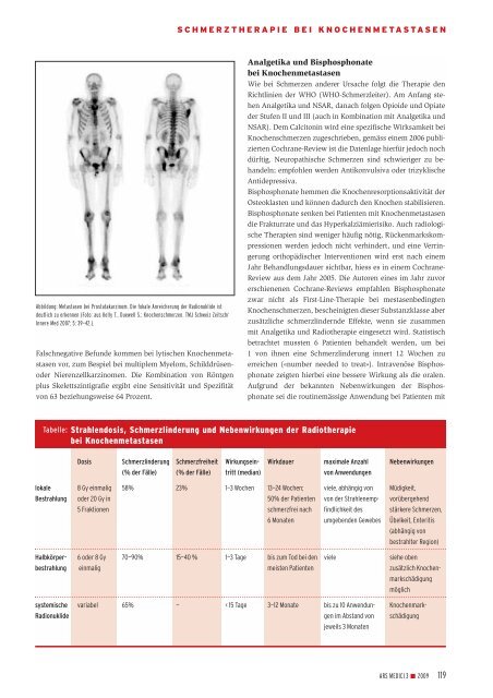 Schmerztherapie bei Knochenmetastasen