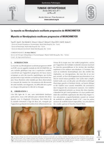 La myosite ou fibrodysplasie ossifiante progressive de ... - sotcot