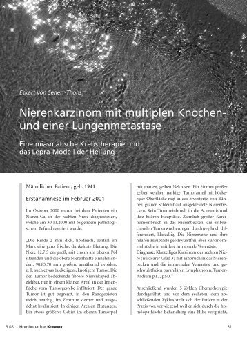 Nierenkarzinom mit multiplen Knochen- und einer Lungenmetastase