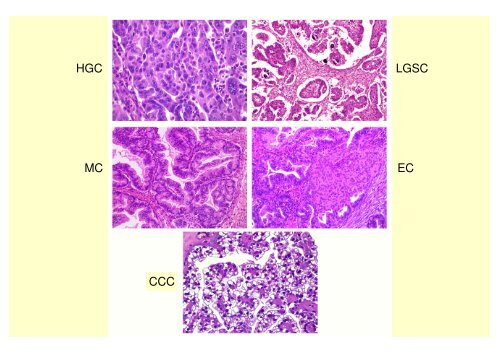 FIGO Proposal for Staging Cancer of the Ovary, Fallopian Tube and ...