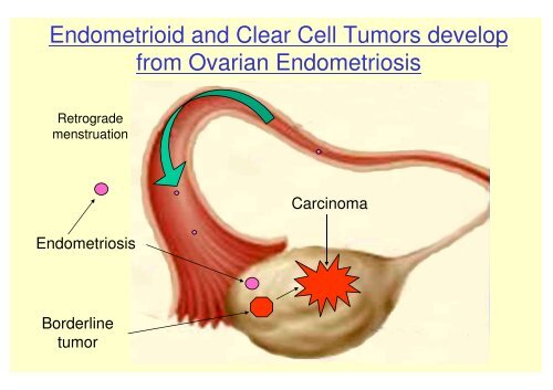 FIGO Proposal for Staging Cancer of the Ovary, Fallopian Tube and ...