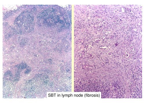 FIGO Proposal for Staging Cancer of the Ovary, Fallopian Tube and ...