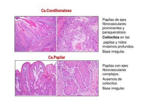 Nuevas entidades de Carcinoma de Pene y subtipos de PeIN