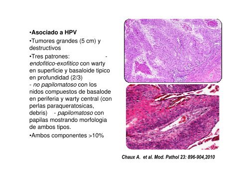 Nuevas entidades de Carcinoma de Pene y subtipos de PeIN