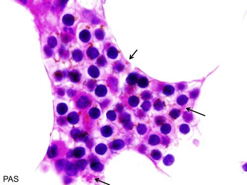 Neoplasias mieloides