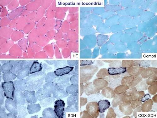 TÃ¨cnicas de histoquimica ,IHQ y utilidad diagnostica en patologÃ­a ...