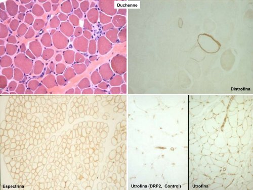 TÃ¨cnicas de histoquimica ,IHQ y utilidad diagnostica en patologÃ­a ...