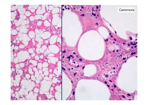 Dermatitis de interfase vacuolar