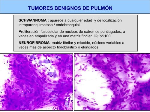 tumores mesenquimales de pulmÃ³n