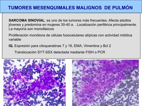 tumores mesenquimales de pulmÃ³n