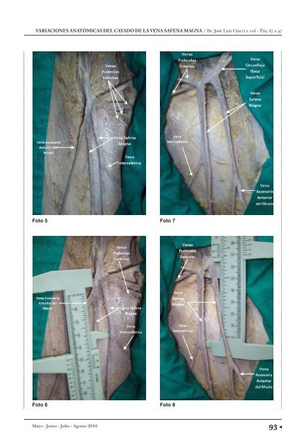 variaciones anatÃ³micas del cayado de la vena safena ... - caccv.org.ar