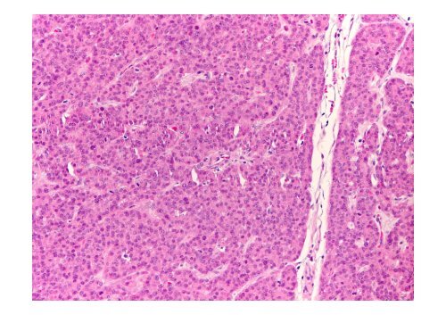 Neuroendocrine Tumors of the Pancreas