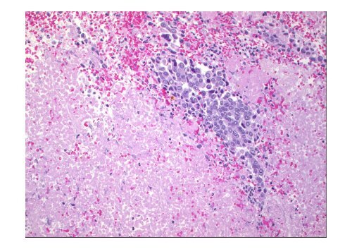 Neuroendocrine Tumors of the Pancreas