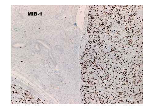 Neuroendocrine Tumors of the Pancreas