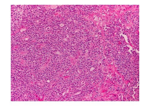 Neuroendocrine Tumors of the Pancreas