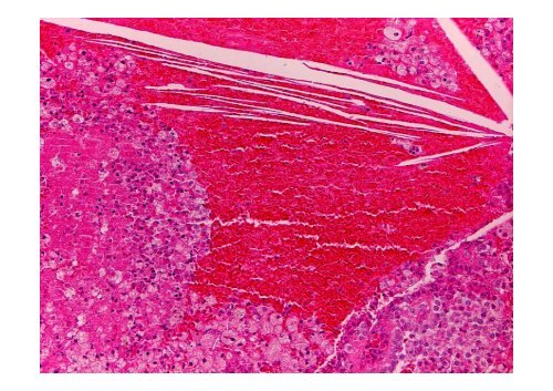 Neuroendocrine Tumors of the Pancreas