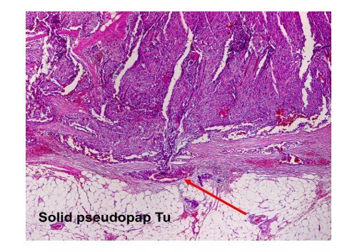 Neuroendocrine Tumors of the Pancreas