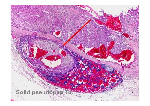 Neuroendocrine Tumors of the Pancreas