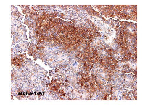 Neuroendocrine Tumors of the Pancreas