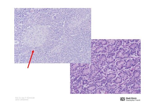 Neuroendocrine Tumors of the Pancreas