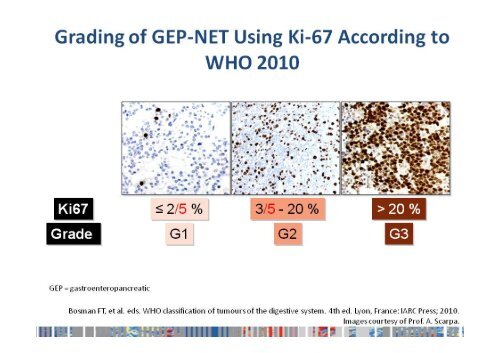 Neuroendocrine Tumors of the Pancreas