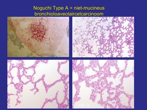 EGFR/k-ras, klinische relevantie bij longcarcinoom - Moleculaire ...