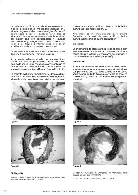 Colitis Ulcerosa Presentación de caso clínico aproximadamente rectosigmoide