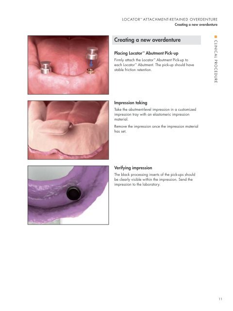 Attachment-retained restorations