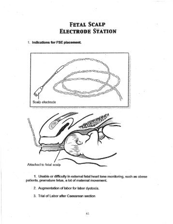 Fetal Scalp Electrode