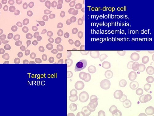 Blood smear