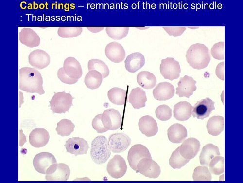 Blood smear