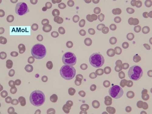 Blood smear