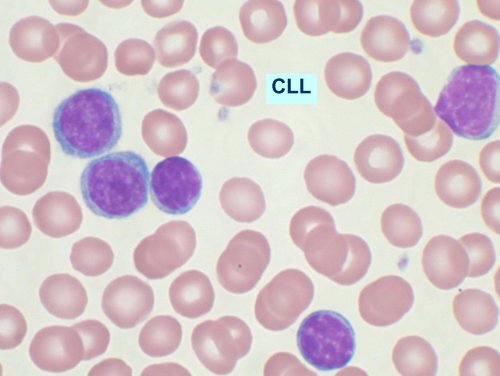 Blood smear