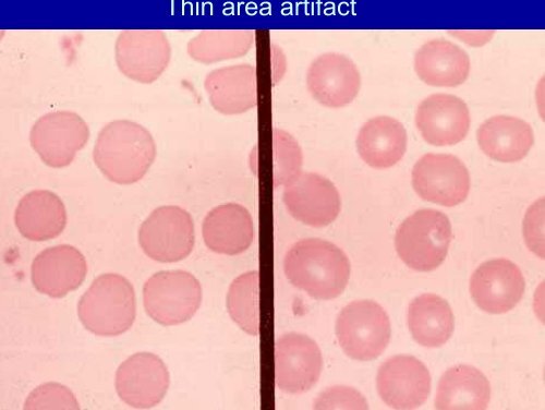 Blood smear