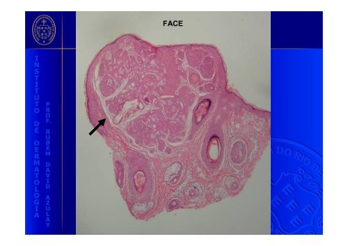 Polimorfismo clínico do hamartoma folicular basalóide