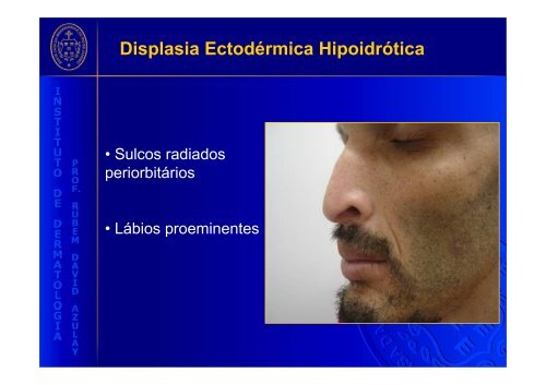 Displasia Ectodérmica Hipoidrótica (Síndrome de Christ-Siemens-Touraine)