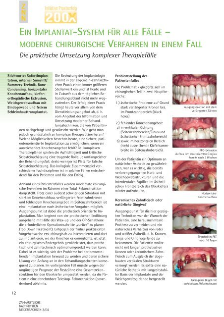 EIN IMPLANTAT-SYSTEM FÜR ALLE FÄLLE - Zahnärztekammer ...