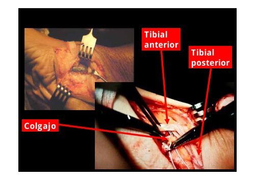 DOBLE Y TRIPLE ARTRODESIS