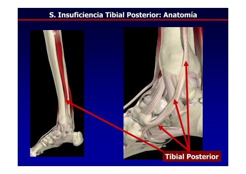 Patología del Tibial Posterior