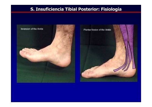 Patología del Tibial Posterior