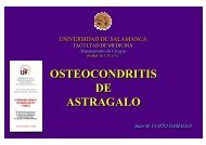 OSTEOCONDRITIS DE ASTRAGALO