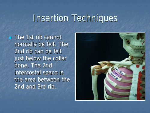 Needle Thoracostomy (Pleural Decompression)