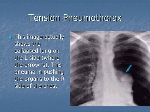 Needle Thoracostomy (Pleural Decompression)