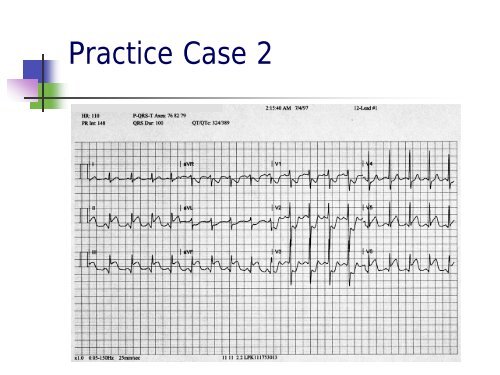 12 Lead ECGs Ischemia Injury & Infarction Part 3